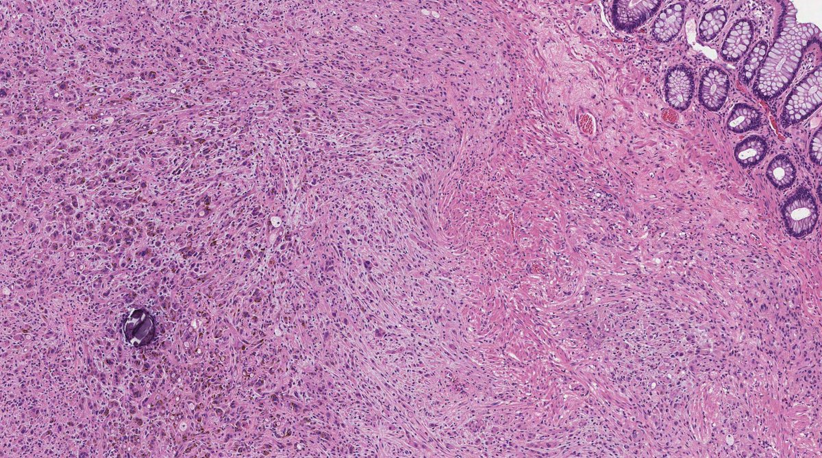MeredithKHerman's tweet photo. Can you get this BOGO deal? 👀

Four distinct lesions in one person.

Name the lesions...and the genetic association that ties them all together!

#PathX #PathQuiz #BreastPath #GIPath #dermpath #ABPath https://t.co/7PGpUzFv9J
