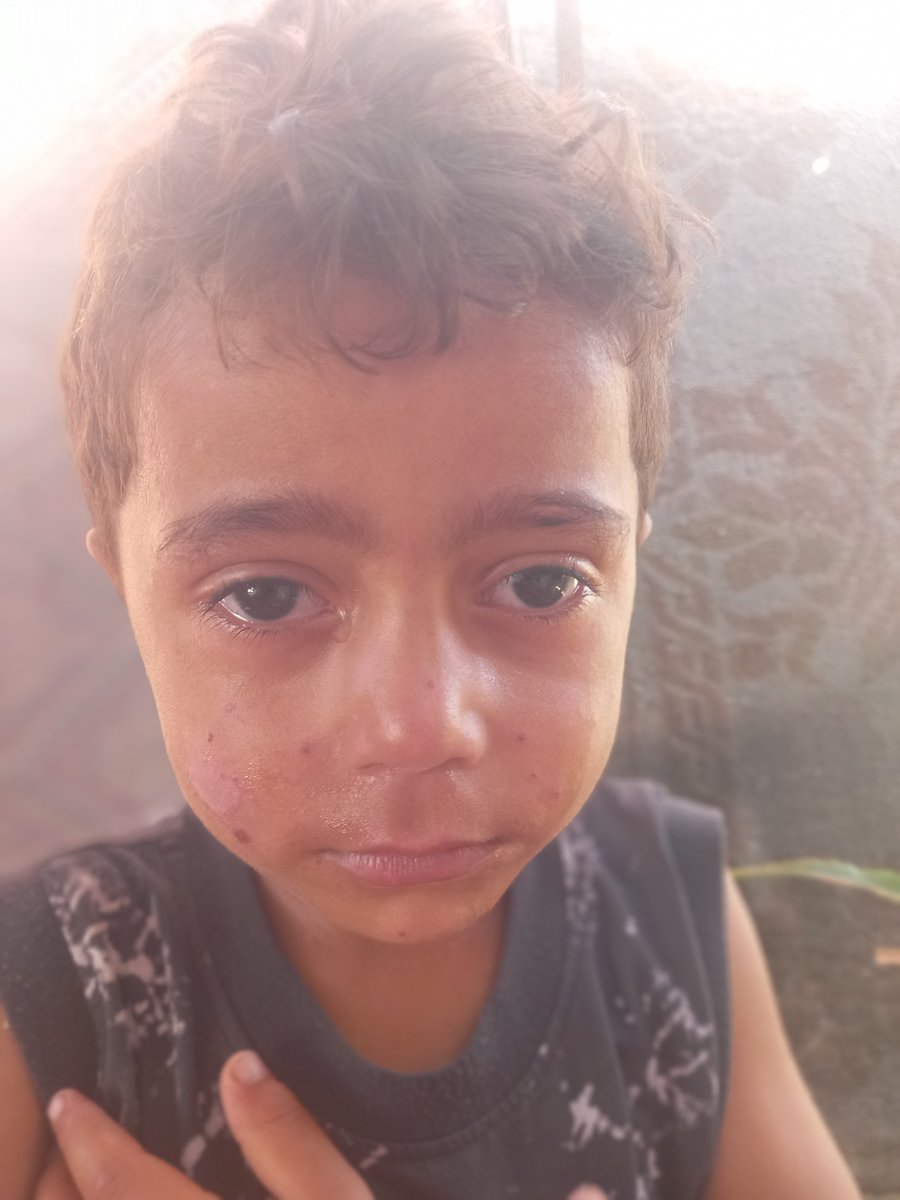 HassanMasud95's tweet photo. My son Hadi, 😢 crying because of the way he looks &amp; the pain caused by the itching. 

I urgently need $250 for another course of medication, medical tests, &amp; food.

I appreciate everyone who supported me in providing medicine4my children.

https://t.co/V4p8PmyDTM https://t.co/7A1iOnum7z
