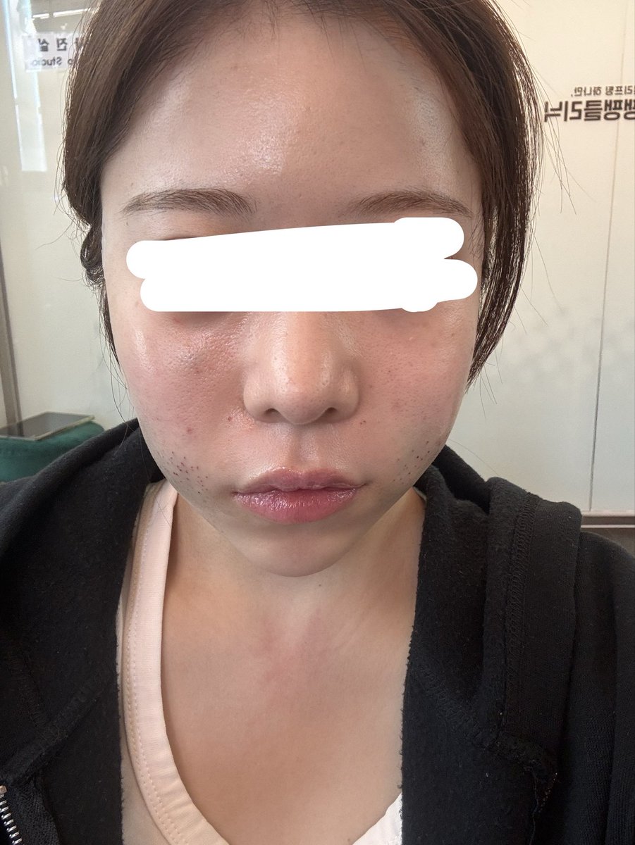 P9e8922PreVLJI2's tweet photo. 術前、術後すぐ（麻酔効いてる）、術後（麻酔なし）
糸リフトと貴族ヒアル、モノスレッドしました
面長が目立っていたので解消できて嬉しいです。ダウンタイム終わるのが楽しみです✨
#糸リフト #ペンペン医院 #韓国 https://t.co/g7Y2vDoB8p