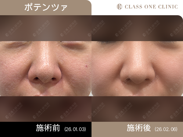 KBGGORG's tweet photo. CLASSONE CLINIC
ポテンツァ 症例写真

実際の症例写真で変化をチェック👀

ご予約・お問い合わせはLINEから📩

#CLASSONE #ポテンツァ #肌管理 #肌質改善 #症例写真 #韓国美容 #韓国美容医療 #GC美容コンシェルジュ https://t.co/uE8P8lONAf