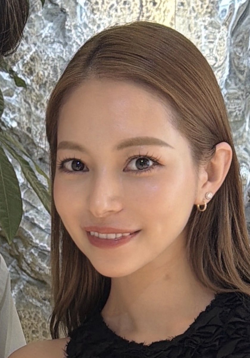 dr_omiomi's tweet photo. これこそ僕がずっと言っている 「余白」の話です。

「目・鼻・口の位置は変えられないから、整形しても意味ない」

実はそんなことありません。

パーツそのものを動かさなくても、周囲の“余白”を変えることで、パーツの見える位置・顔全体の重心は変えられます😌

例えば輪郭形成で下顔面の余白(頬、ジョール、バッカル)を減らす。
中顔面はナゾラビアルを無くしてチークトップを高くして立体感を作る。

すると同じ目・鼻・口でも、相対的な位置関係が変わり、顔全体の印象はかなり変わります。

垢抜けは、パーツ単体より顔全体のバランスがめちゃくちゃ大事です✨