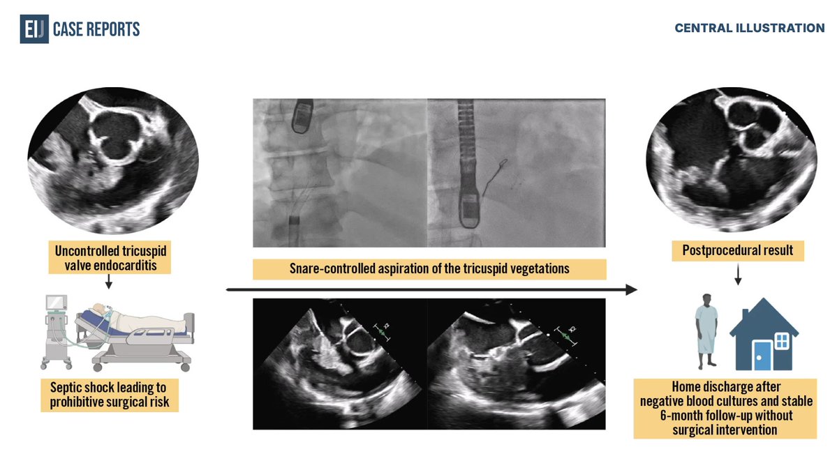 sbrugaletta's tweet photo. A tricuspid valve (TV) vegetation is identified in 47yo male on echocardiography with rapid clinical deterioration and escalating vasopressor support necessitated intubation and mechanical ventilation. Despite targeted antibiotic therapy, blood cultures remained persistently positive with ongoing pyrexia. A multidisciplinary Heart Team meeting opined that ongoing seeding from the large TV vegetation was a likely contributor to the limited response to antimicrobial therapy. Emergent surgical intervention was considered prohibitively high risk due to deteriorating haemodynamics. Discover how a transcatheter debulking of the TV vegetation was performed saving pt life @EIJCaseReports @PCRonline @escardio @TCTMD @JACCJournals @shci_sec 
https://t.co/bKNaQIO2sh