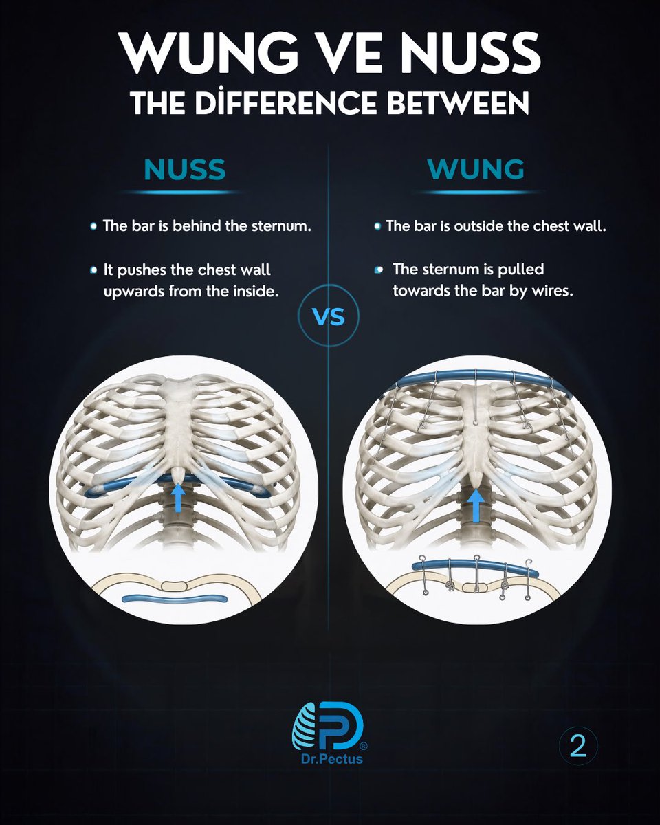 drpektus's tweet photo. 🩺 What Is the Wung Procedure in Pectus Excavatum Treatment? How Is It Different from the Nuss Procedure?

Pectus Excavatum is a chest wall deformity characterized by an inward depression of the sternum and anterior chest wall. https://t.co/l9Y0lnQh3B