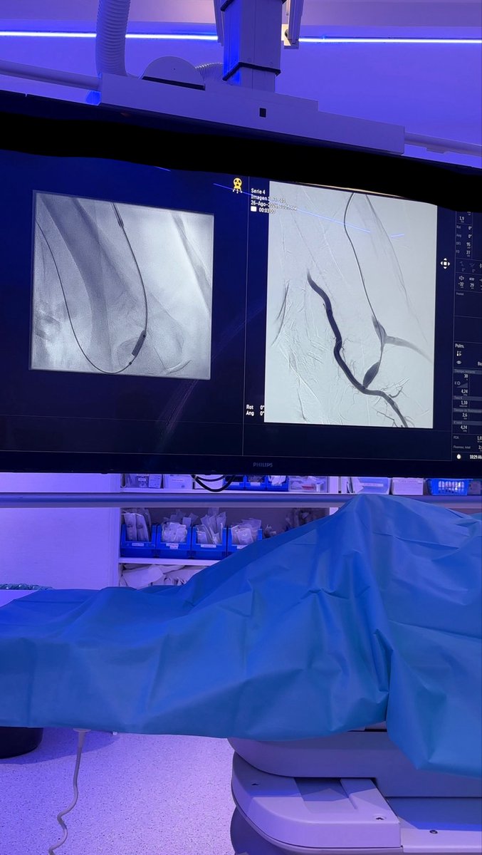 dr_figue's tweet photo. Una FAV deja de funcionar.
Entras, haces una fistulografía, encuentras dónde está la estenosis, dilatas con un balón y recuperas el flujo.
Caso de hoy en Intervencionismo.
No voy a negar que ver el resultado inmediatamente tiene algo bastante satisfactorio. #rvi #resrad https://t.co/ZFIMOMqWXg
