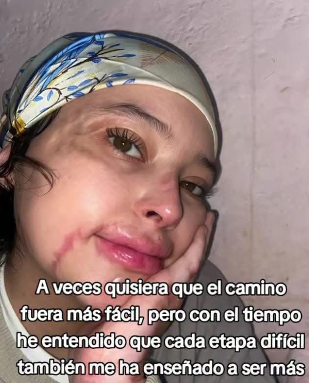 ElizbethCristi7's tweet photo. 🚨 #JUSTICIA | Sara Zambrano, una joven de apenas 16 años, sobrevivió a una tragedia que le cambió la vida.

Según el relato de su familia, Sara se encontraba en una fábrica de perfumes cuando, presuntamente, cuatro menores —dos mujeres y dos hombres— habrían rociado alcohol dentro de una habitación cerrada y luego habrían encendido una mechera, en un hecho que la familia considera un intento de quemarla viva.

Sin embargo, familiares de los jóvenes y los propietarios de la fábrica sostienen que se trató de un accidente. ⚠️

Sara sufrió quemaduras en cerca del 80 % de su cuerpo, permaneció 17 días en coma y estuvo aproximadamente siete meses hospitalizada. Ha enfrentado múltiples infecciones y alrededor de 70 cirugías.

Hoy, su familia pide que se esclarezcan los hechos y que, si se determina que hubo responsables, se haga justicia. Mientras tanto, Sara lucha por recuperar su vida, terminar el bachillerato y cumplir su sueño de estudiar Medicina u Odontología. 🙏🏽

Un caso que merece una investigación seria, transparente y con todas las garantías del debido proceso.