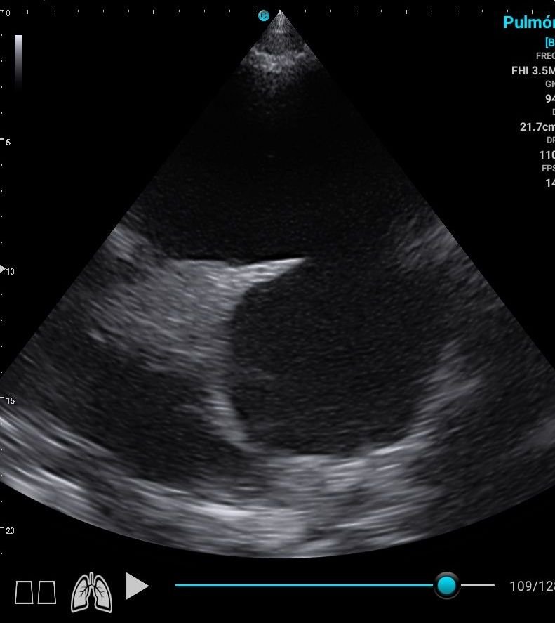 mdmarior's tweet photo. Whale-tail sign.

On US you see pleural effusion, the collapsed lung moves back and forth with respiration, resembling a whale's tail.

#pocus #emergencymedicine #urgencias https://t.co/mG7m8AyNoN