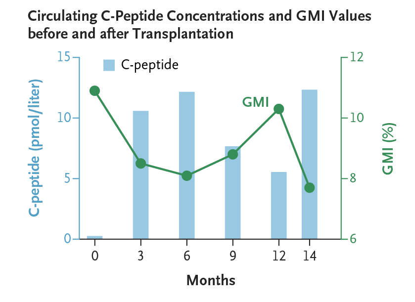 NEJM's tweet photo. A patient with type 1 diabetes received genetically modified allogeneic islets and no immunosuppression. Results obtained through 14 months support β-cell function and a lack of immune response against the allograft. Full study results: https://t.co/XBUIkNp59s https://t.co/xuY9dQ07wA