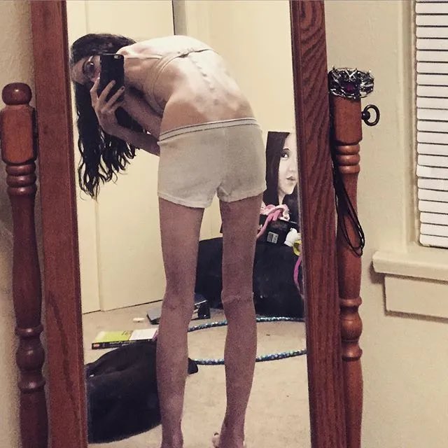 SkinnyAdmirer's tweet photo. #thinspo #thinspO0 #bonespo #bonesp0 #deathspo #deathsp0 #edtwt #anablur #edtw #twana #twed #edblur #edtblur #ed #anatw #proana #edrtwt #shedtwt https://t.co/7WpwIwpJht