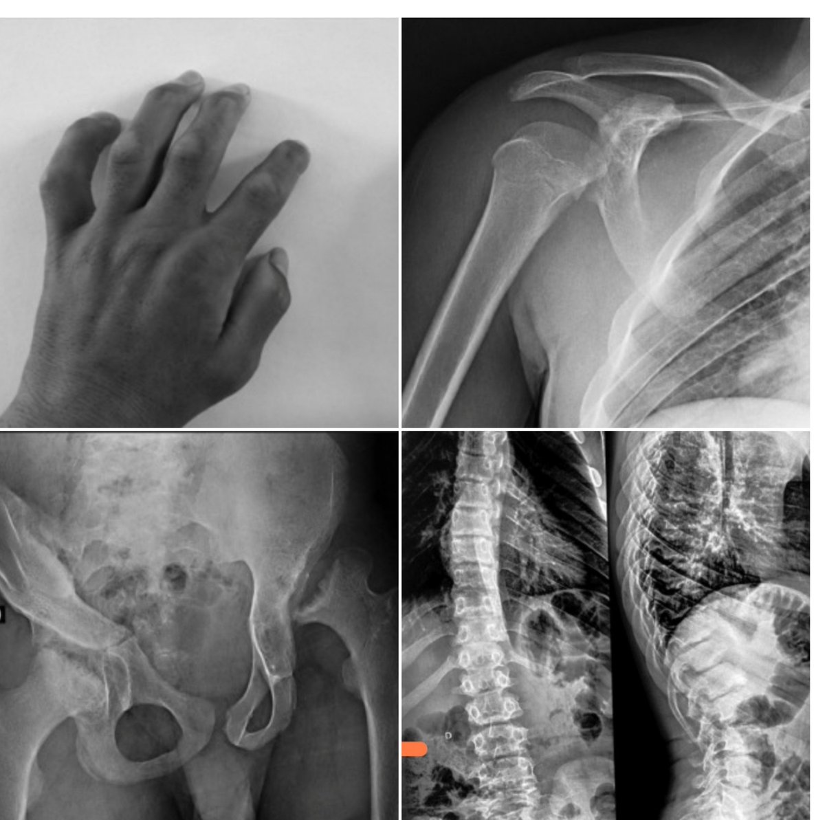 reinmd77's tweet photo. 16yo♂️poly⚡
"JIA"
FHx sibling simil
IFX 7yrs?
no -itis, deformity 
⚗️⚗️✔️
📸🎞️
🪒
Urinary glycosaminoglycan: MPS 
🧬GALNS
◾Morquio syndr
https://t.co/D3GYyHLCAs https://t.co/PXpXYqRMjJ