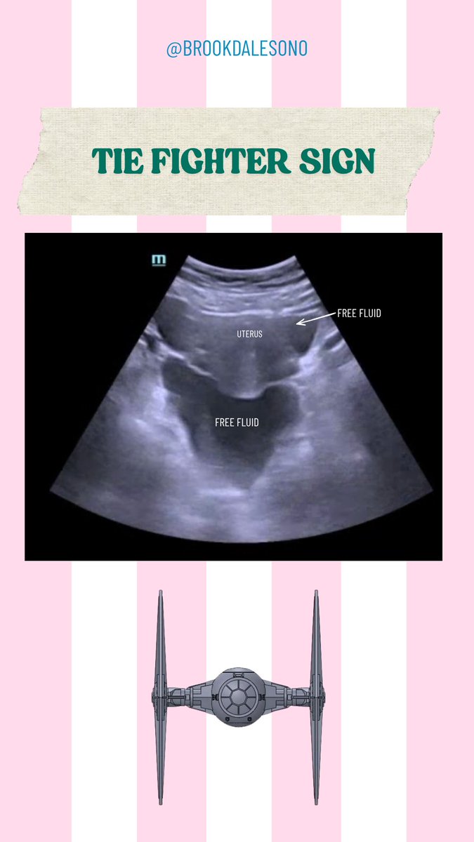 BrookdaleSono's tweet photo. If only this was Star Wars...
39 yo F presenting with vaginal bleeding and syncope.
US Findings:
- #TIEfightersign - Uterus floating in free fluid
- #TubalRing - Suggestive of R Tubal Ectopic
#POCUS #RupturedEctopic #FOAMed #BrookdaleSono https://t.co/zRBoCFWOwG