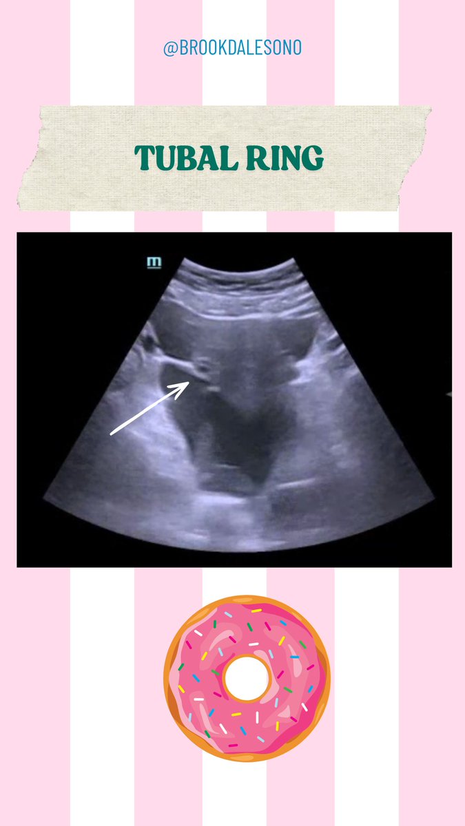 BrookdaleSono's tweet photo. If only this was Star Wars...
39 yo F presenting with vaginal bleeding and syncope.
US Findings:
- #TIEfightersign - Uterus floating in free fluid
- #TubalRing - Suggestive of R Tubal Ectopic
#POCUS #RupturedEctopic #FOAMed #BrookdaleSono https://t.co/zRBoCFWOwG