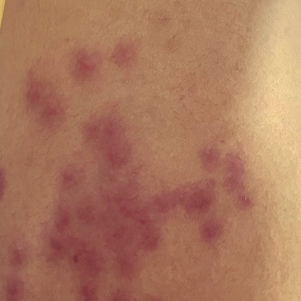 liliilonayy's tweet photo. @unsoedmfs SUMPAH INI BUKTI LENGAN GUE…trauma jujur karena gatel,panas, perih gue garuk sampe merah….dan yang paling parah bekasnya ga ilang jadi jelek bgt tangan gue gara gara kutu kopken…TRAUMA💔💔💔 https://t.co/TrWLnFKFzx