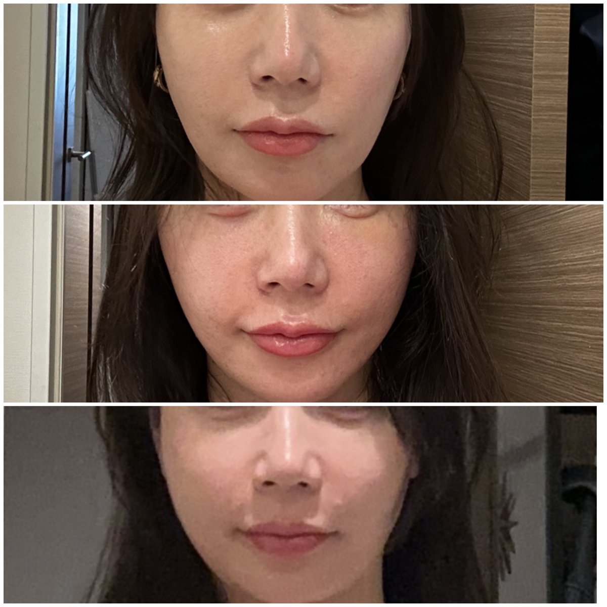 ミニ切開リフトから半年
後戻りありますか？ってDMで質問頂いたので写真作って送ったのでこちらでも共有します😊
結論、ほぼ後戻りしていないと思います😆
上　術前
中　術後1週間
下　現在（術後半年） https://t.co/Ib57sZaRjh