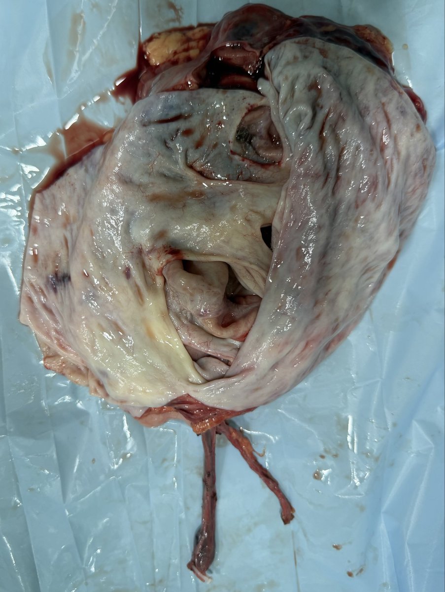 PrajwalPaudyal's tweet photo. Laparoscpic nephrectomy for giant hydronephrotic kidney : 20 cm kidney extracted out from just 4 cm incision https://t.co/XR30S6wdrA