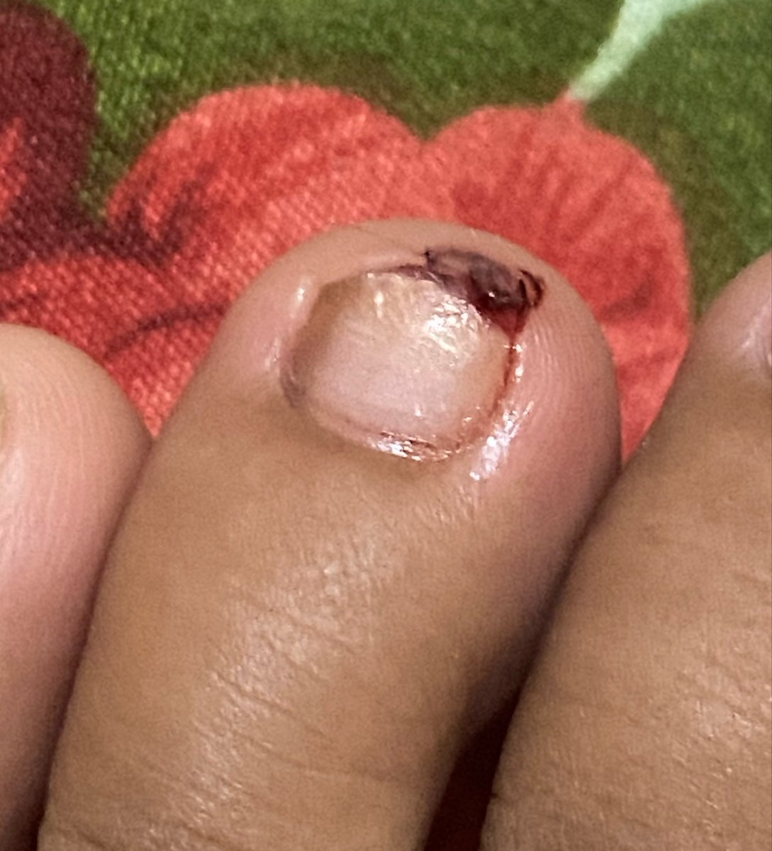 simanislalaa's tweet photo. sebenernya gatau knp bisa sampe luka berdarah dan SAKIT, padahal kayak cmn jalan kesandung aja… dan tadi pagi masih hrs pake sepatu walaupun sakitnya ditahan😭 https://t.co/v39Ph7kLVU