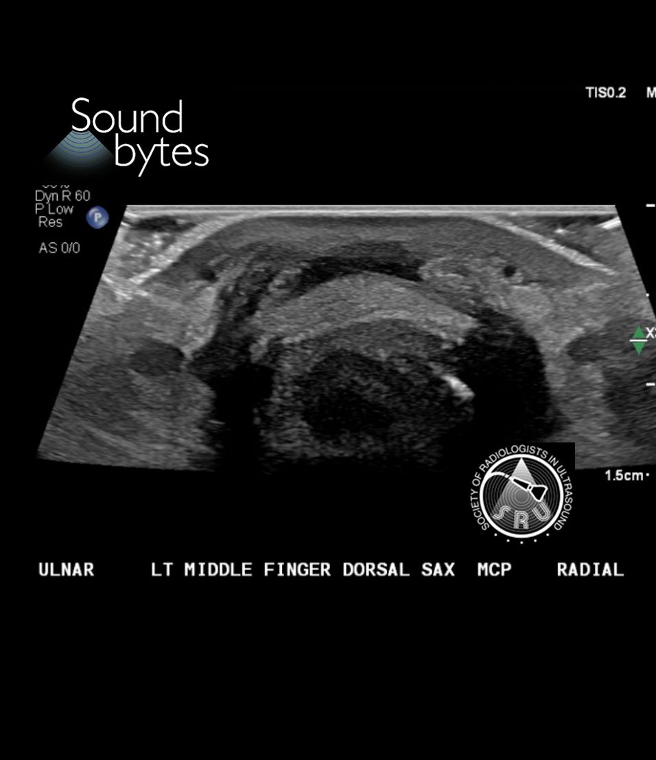 sruradiology's tweet photo. 20F p/w laceration along the dorsal aspect of the left 3rd digit at the MCP joint. What's your sound diagnosis?
Case courtesy of Katherine Copely, MD, University of Kentucky, @RadKatMD
#RadResidents #ultrasound #RadInTraining https://t.co/yPuDj9vYao