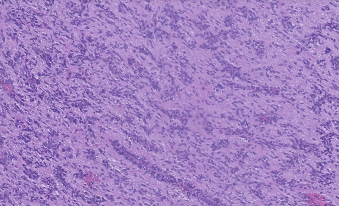 PeterKobalka's tweet photo. Angiocentric glioma, WHO grade 1.  Note the impressive number of bipolar spindle cells concentrated around vessels.  A MYB::QKI fusion was detected.  #Neuropath #Neuropathology #CNSpathology #Pathtwitter #PathX https://t.co/zdoHFnrnX4