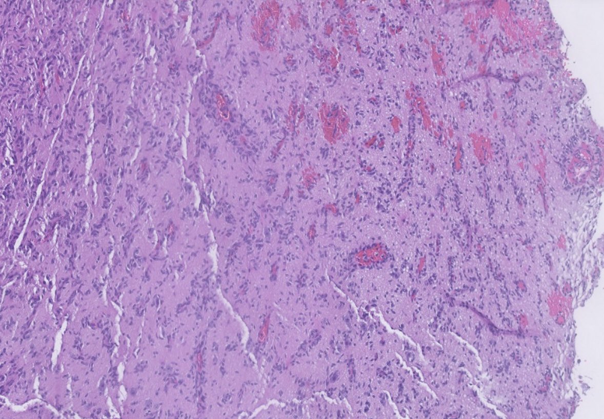 PeterKobalka's tweet photo. Angiocentric glioma, WHO grade 1.  Note the impressive number of bipolar spindle cells concentrated around vessels.  A MYB::QKI fusion was detected.  #Neuropath #Neuropathology #CNSpathology #Pathtwitter #PathX https://t.co/zdoHFnrnX4