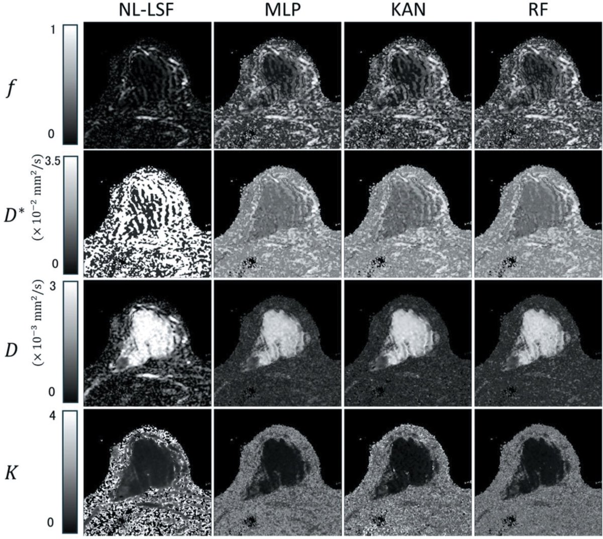 in_magnetic's tweet photo. Advancing breast cancer MRI. A novel synthetic Q-space learning (synQSL) approach for IVIM-DKI parameter estimation outperforms conventional methods. It provides faster computation and robust differentiation of benign vs malignant tumors. https://t.co/bL0MCSRdnq https://t.co/SulNJNvQRq