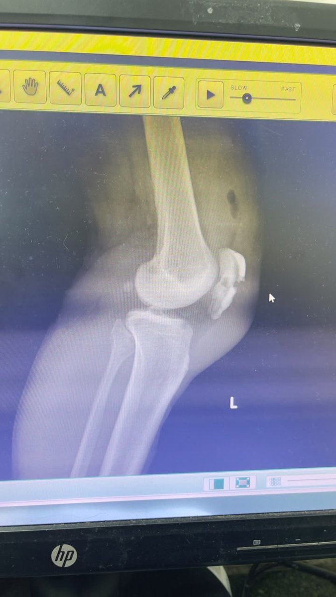 Latin_Maxi's tweet photo. Im sorry my followers im dont go online because me have one big accident  with my leg  and im dont  know when go online again https://t.co/8ZYwIthPgu
