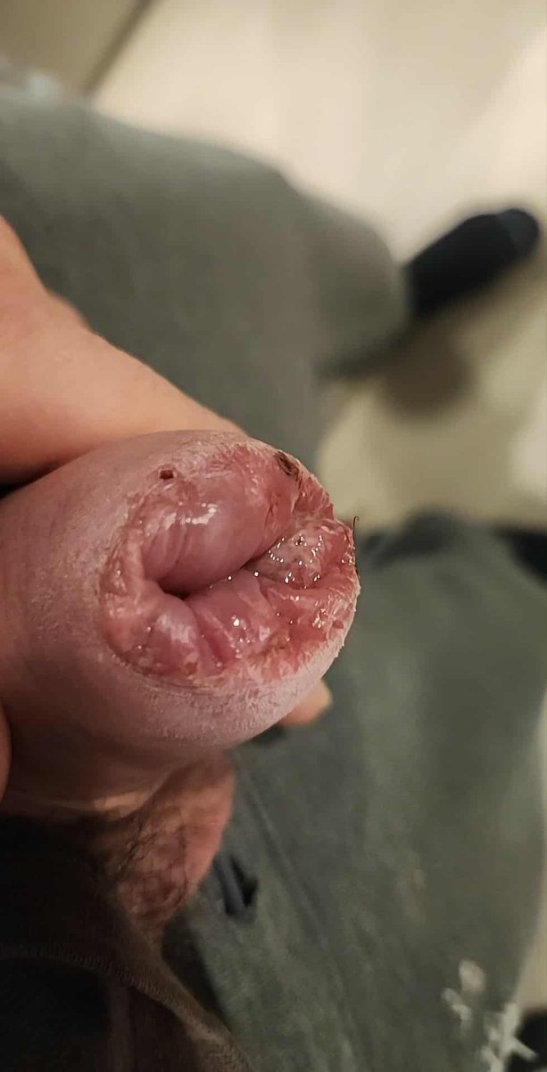Kendall_D_Lowry's tweet photo. Bad news for the #NFL the #Broncos best player #AlexFiset #AlexBoomBoom confirmed out for next game with a genital injury. His boyfriend's @BrungianDynasty ass has a new cock eating disease, look what it caused.... https://t.co/0BgnRKyRbh