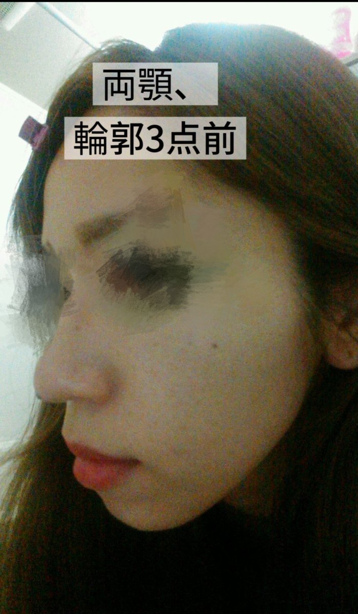 shizenjanaichan's tweet photo. @SEOULTUK オトガイ骨切り再手術から一年！
術前は顎の前方移動が足りなくて、両顎と輪郭3点してたけどまだ口ゴボみあり���
4枚目に全く骨いじる前の口ゴボってかナス？🍆の私置いておきます https://t.co/EtN85lpI36