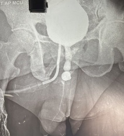 PrajwalPaudyal's tweet photo. In near-obliterative bulbar urethral strictures, double-face BMG urethroplasty involves a small ventral inlay graft combined with a larger dorsal onlay graft to achieve adequate urethral lumen augmentation. https://t.co/g5BMv6vmM9