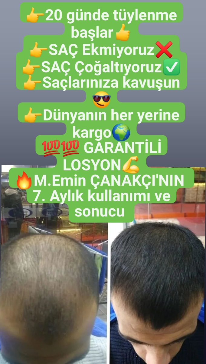 mavvilosyon's tweet photo. 🌞 HAYIRLI SABAHLAR 🌞

🔥 BAY-BAYAN SAÇ BAKIM SERUMU 🔥

💎 GÜÇSÜZ &amp; CANSIZ SAÇLARA
💎 ZAYIF VE SEYREK GÖRÜNEN SAÇLARA
💎 DÖKÜLMEYE KARŞI SAÇ BAKIMI

⏰ 1–1,5 ay içerisinde farkı gözlemlemeye başlayabilirsiniz.
💧 1 ŞİŞE: 60 ML
📆 1 AY’lık

📩 Detaylı bilgi ve sipariş için DM! https://t.co/awnVp5vgKI