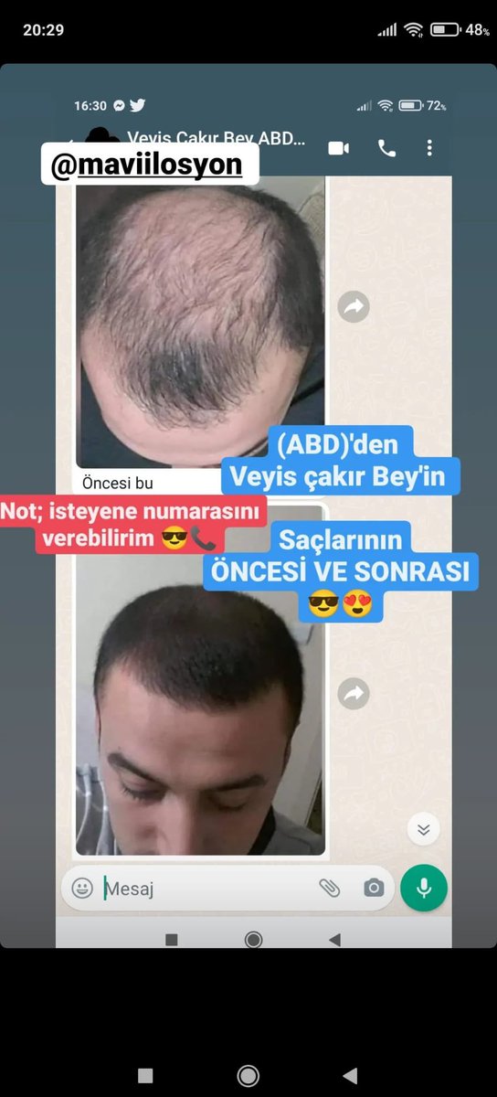 mavvilosyon's tweet photo. 🌞 HAYIRLI SABAHLAR 🌞

🔥 BAY-BAYAN SAÇ BAKIM SERUMU 🔥

💎 GÜÇSÜZ &amp; CANSIZ SAÇLARA
💎 ZAYIF VE SEYREK GÖRÜNEN SAÇLARA
💎 DÖKÜLMEYE KARŞI SAÇ BAKIMI

⏰ 1–1,5 ay içerisinde farkı gözlemlemeye başlayabilirsiniz.
💧 1 ŞİŞE: 60 ML
📆 1 AY’lık

📩 Detaylı bilgi ve sipariş için DM! https://t.co/G9r4MDNJeq