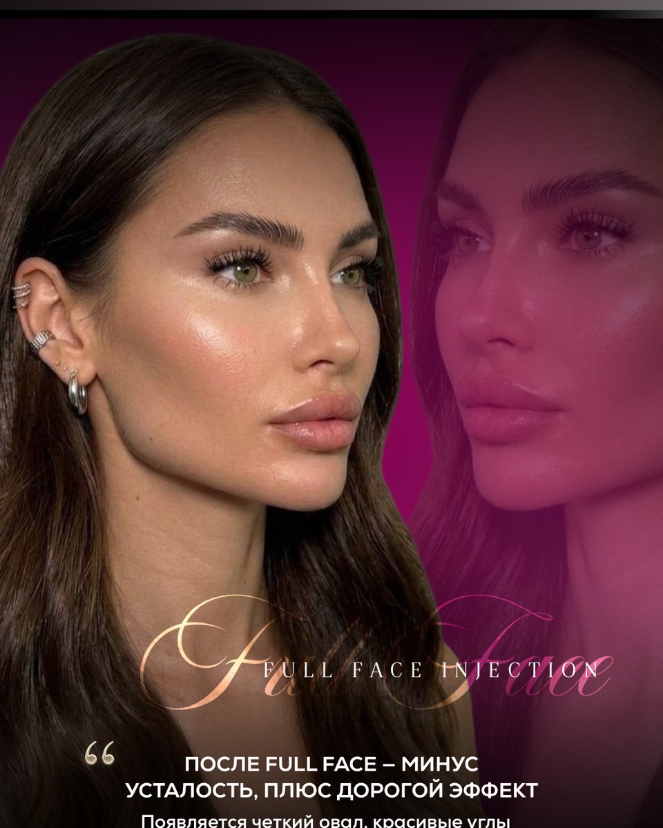 TequilaByan's tweet photo. Cancún 
August 8, 9, 10 
Full face: 10, 500 MXN 
5 ml filler + lips + Botox 
Lips only: 3, 500 MXN 

Full-face fillers + Botox restore volume, soften wrinkles, enhance facial contours, and create a natural lifting effect. Results last 6 months to 2 https://t.co/ibH7DuhE5J
