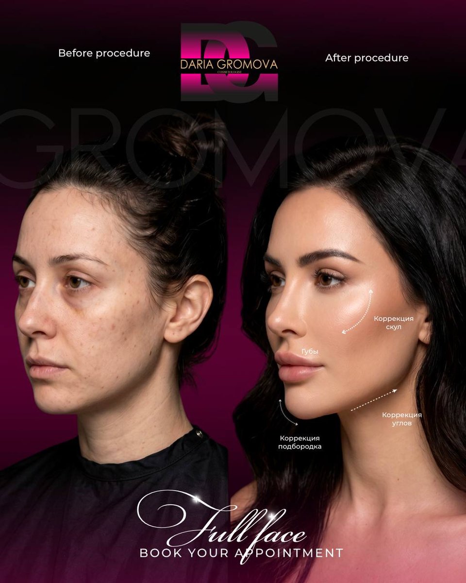 TequilaByan's tweet photo. Cancún 
August 8, 9, 10 
Full face: 10, 500 MXN 
5 ml filler + lips + Botox 
Lips only: 3, 500 MXN 

Full-face fillers + Botox restore volume, soften wrinkles, enhance facial contours, and create a natural lifting effect. Results last 6 months to 2 https://t.co/ibH7DuhE5J