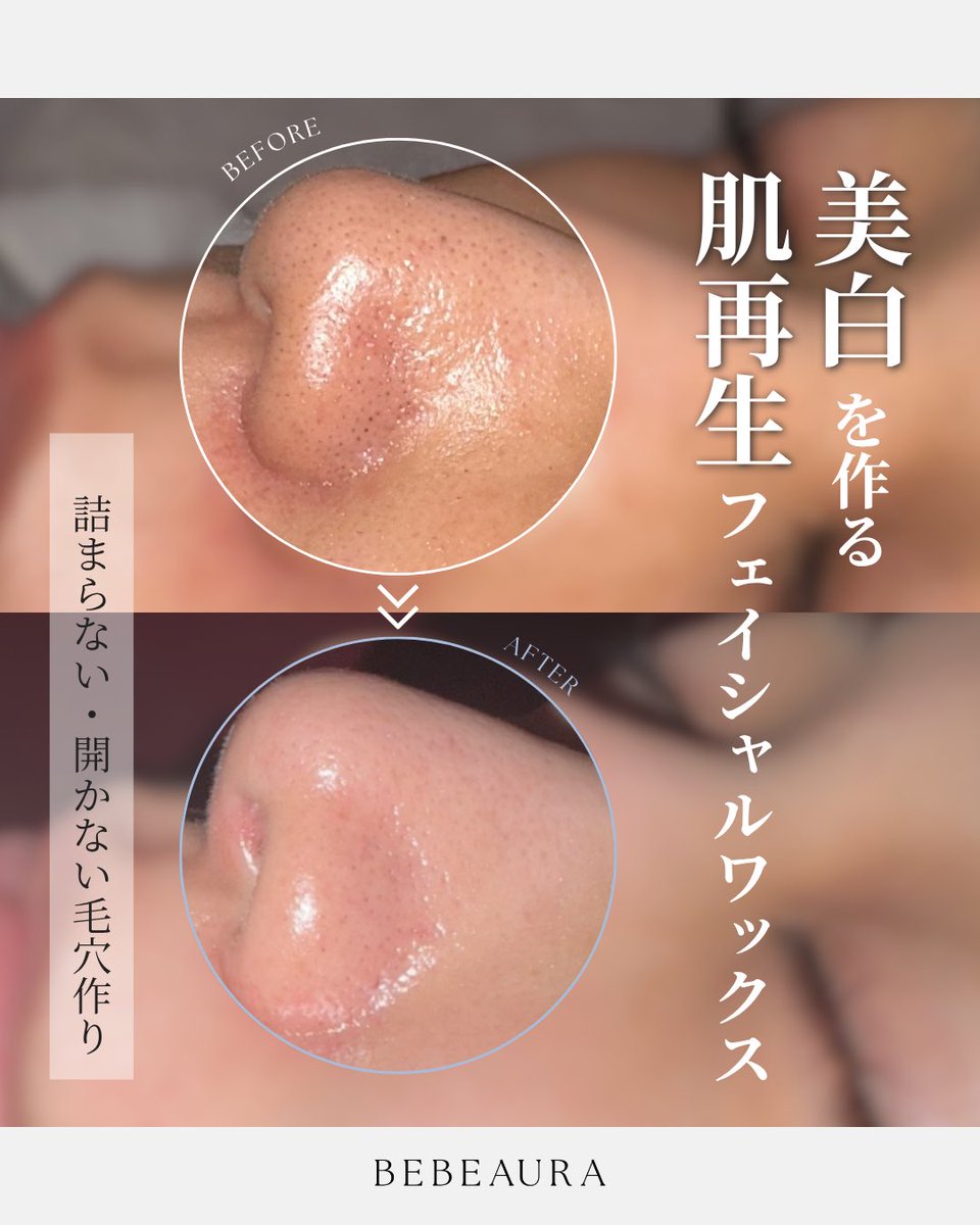 bebeaura_salon's tweet photo. せっかくの美白も毛穴が黒ずんでいては勿体無い！！！

☑︎毛穴の黒ずみが気になる
☑︎ピーリングしているのに毛穴の詰まりが改善しない
☑︎艶肌になりたい🤍

そんな方はビボーラ肌育WAXで毛穴の大掃除を🧹

即艶肌！
3日後、1週間後にはさらに肌がつるん💎 https://t.co/MEoRzTly8w