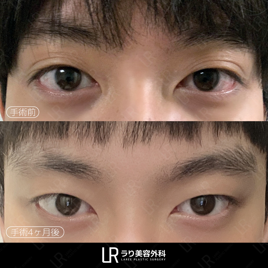 lareeclinic's tweet photo. 「目が大きくて悩んでいる？」

目が大きく出て見えて、
二重ラインも何重にもあると
負担に感じることも。

一重に近い自然な目元に整えて、
大きな目を少しカバーしながら
重なったラインもすっきり整理。

#メンズ整形 #目元矯正 #一重 #一重形成 https://t.co/SMo61l3fJG