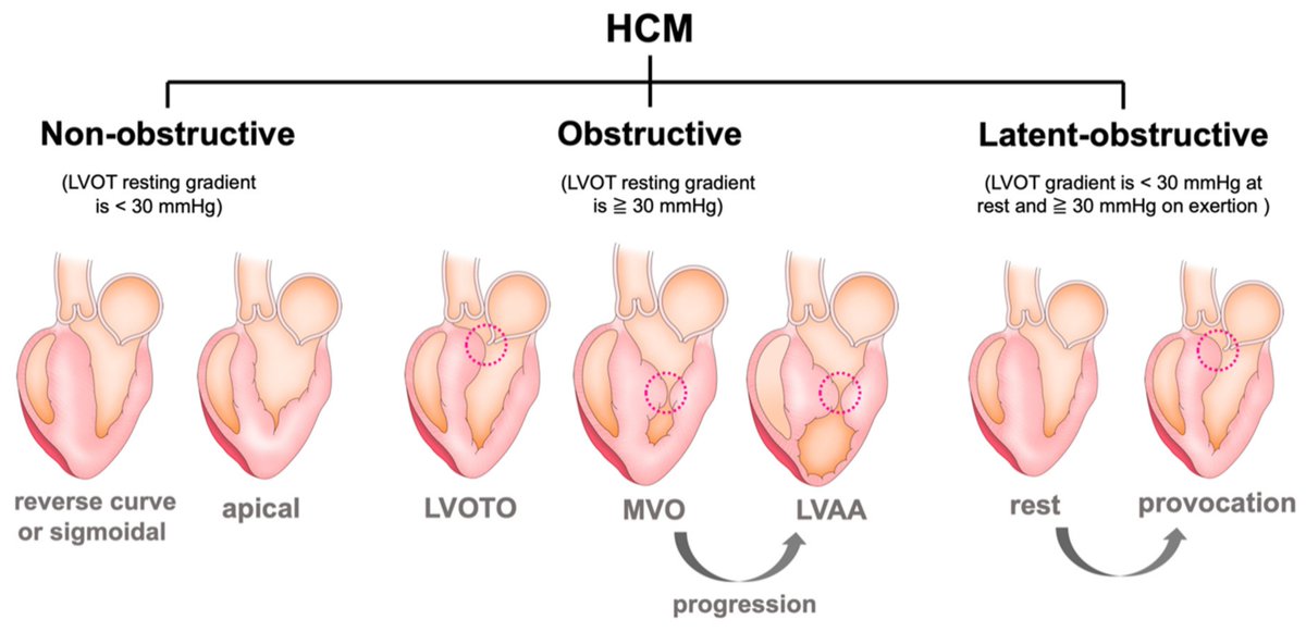 Ahmedata7777's tweet photo. 🫀 Hypertrophic Cardiomyopathy (HCM) — Morphological Types

HCM is not simply “septal hypertrophy.”

The distribution and pattern of LV hypertrophy can vary considerably.

Thread 👇 https://t.co/6AZUMJQnPf