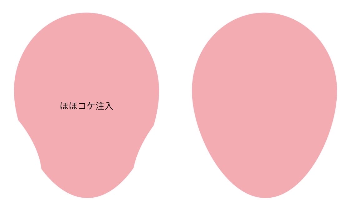 oyama_LOCHIC's tweet photo. あと、もう一つ思うのが、左タイプの痩せが強い人にフェイスリフトをしても、この痩せた輪郭は変わらなくて、あんまり若々しくなってないな、ということがあって、

そういう場合も、「全顔脂肪注入では」と思う。

フェイスリフトは、誰にとっても、必ずしも最強の若返りではない。 https://t.co/7wXgDh94Nd