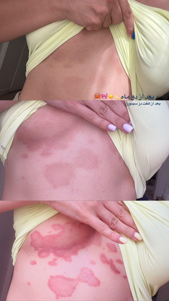 engineerghl's tweet photo. من از پسوریازیس رنج میبرم یعنی میبردم، الان دو ماه شده که درمان دارویی شروع کردم و این تغییرات منه بعد از دز هفتم امپول سینورا🎀🦀 https://t.co/aBreAgQFwx