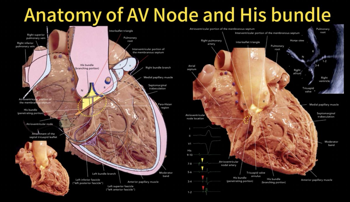 pzhong2016's tweet photo. Anatomy of AV node and His bundle https://t.co/d8QN5Hs8B7