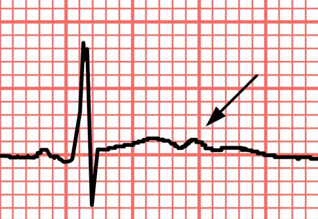 DrPharmDMDTh's tweet photo. What is most likely diagnosis? https://t.co/l79FLDHm97