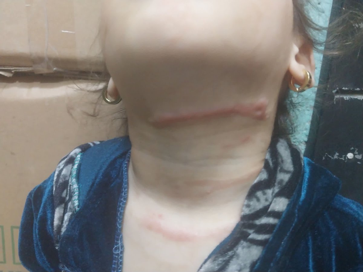 hmd_mhmd9832's tweet photo. 💔 My little girl is burned… the burns on her neck and knees are getting worse every day 😢
My heart is breaking seeing her like this, and I can’t afford her treatment 💔
https://t.co/ZZipoQ2PnT https://t.co/3oDOkiuOGB