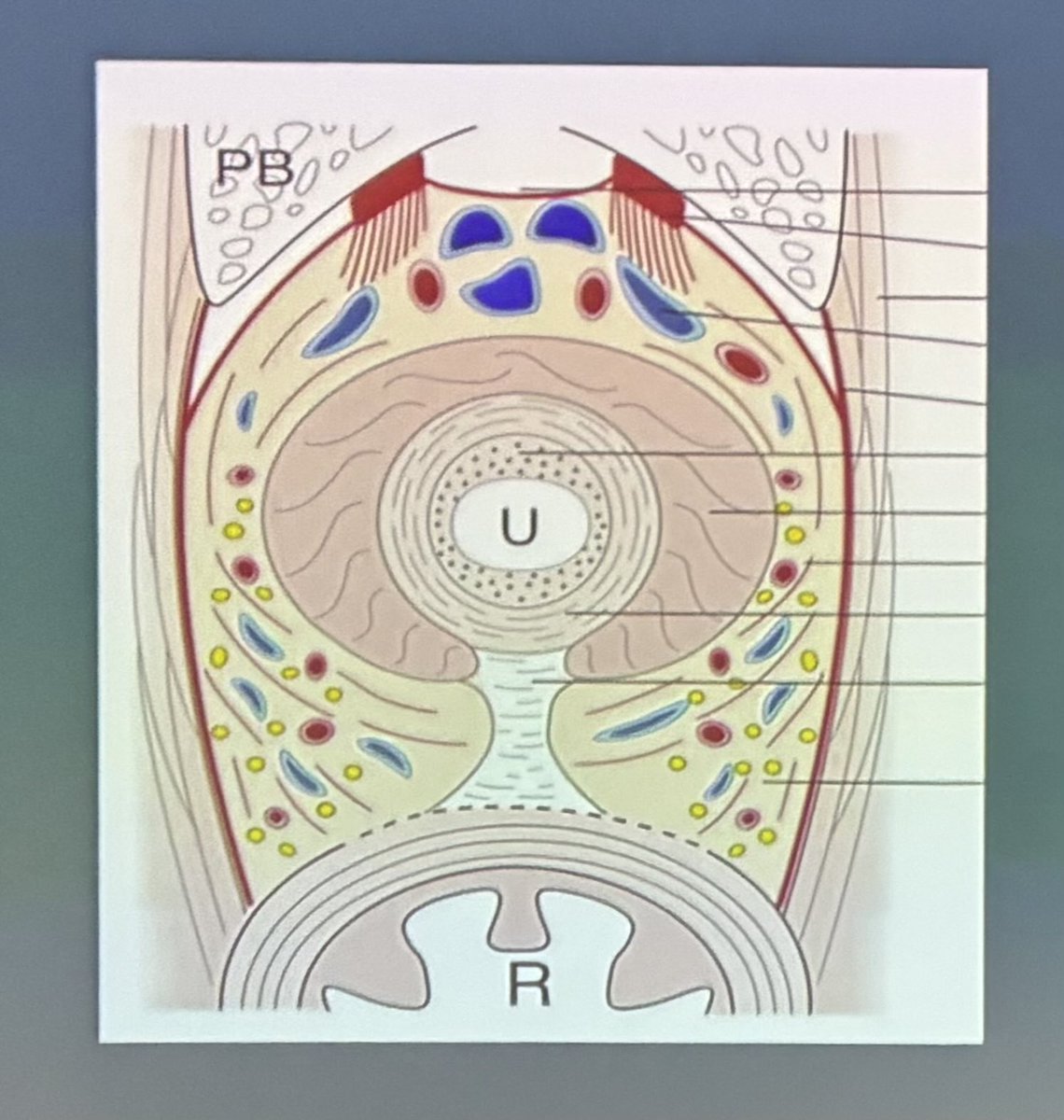 soares_uro's tweet photo. Apical dissection during radical prostatectomy by Dr. Jochen Walz @ERUSrobotics 
1- blunt and cold cut dissection (avoid diathermy)
2- cut DVC, then stitch (stitching DVC before may trap the anterior sphincter)
3- stitch DVC before dissecting urethra for better visualization https://t.co/bSrHdHmYsA