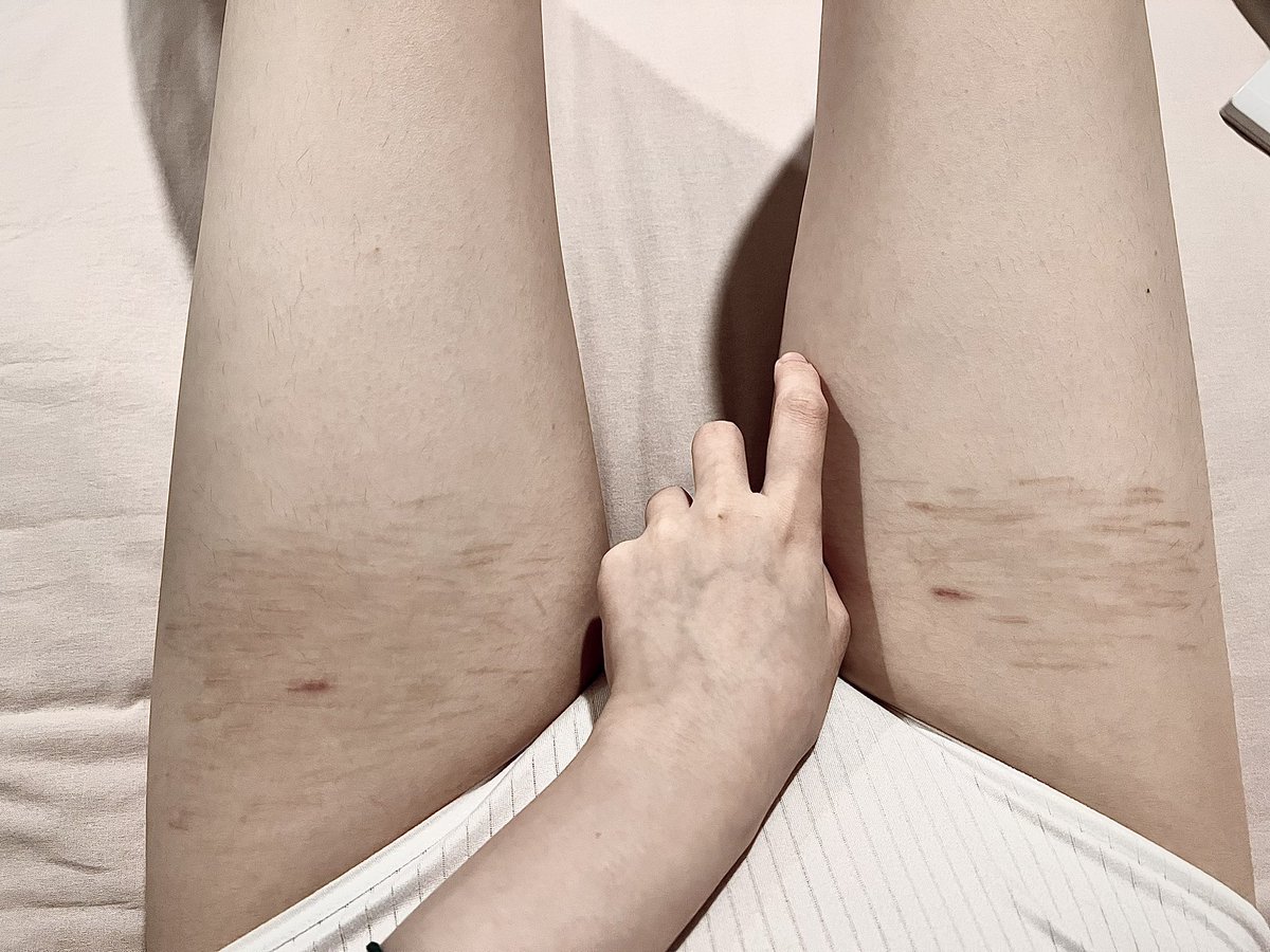 ytmmnvv's tweet photo. old scars https://t.co/buHKdhJdXY