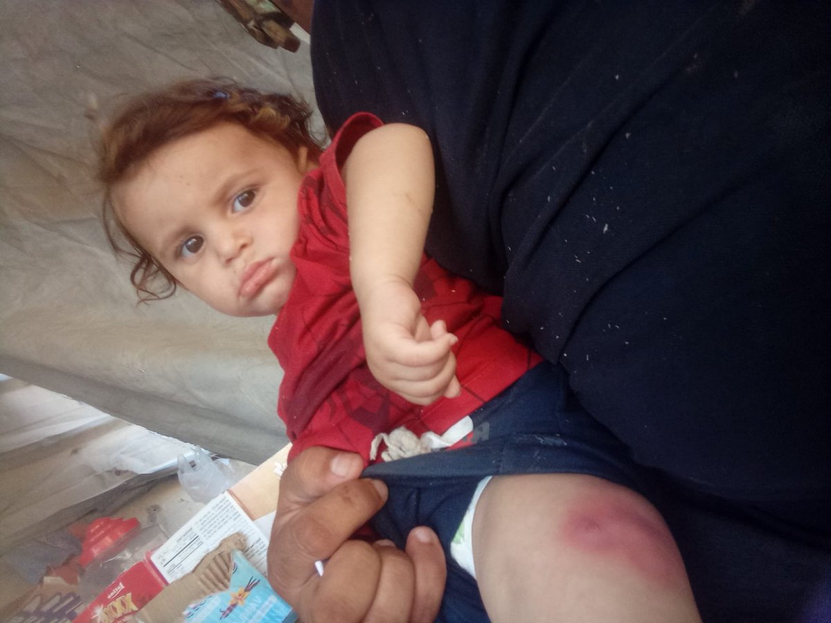 spiritoftebhaga's tweet photo. this baby is going to have a surgery for this affliction. He's only 7 months old. The surgery will cost $150. It's an easy enough amount to raise. 

Please, I beg y'all, please share the campaign and donate if you can. Even a $5 goes a long way ‼️‼️‼️‼️ https://t.co/vJiILGKbb4 https://t.co/NHiJgnufOI