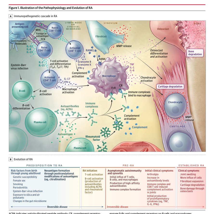 LuisOliverio's tweet photo. Artritis reumatoide (AR), la última revisión de JAMA (2026). Algunos puntos clave:

🟡 No hay criterios diagnósticos de AR. Los ACR/EULAR 2010 son de clasificación. El diagnóstico es clínico: sinovitis en muñeca, MCP y PIP respetando las distales, rigidez matutina >30 min.

🟡 Metotrexate: iniciar 7.5-10 mg/semana y escalar a 20-25 mg/semana en 4-8 semanas, con ácido fólico 1 mg/día o 5 mg/semana. La vía SC  se reserva para intolerancia GI.

🟡 Meta con fecha: mejoría ≥50% del CDAI a los 3 meses, remisión o baja actividad a los 6. Si no, se cambia el FAME.

🟡 Esteroide = puente. Prednisona 5-7.5 mg/día, suspender antes de los 3 meses.

🟡 JAK, si falla anti-TNF (Tofacitinib, Baricitinib, Upadacitinib, Filgotinib).

Ya está todo actualizado en las apps.