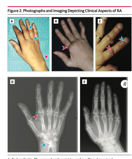 LuisOliverio's tweet photo. Artritis reumatoide (AR), la última revisión de JAMA (2026). Algunos puntos clave:

🟡 No hay criterios diagnósticos de AR. Los ACR/EULAR 2010 son de clasificación. El diagnóstico es clínico: sinovitis en muñeca, MCP y PIP respetando las distales, rigidez matutina >30 min.

🟡 Metotrexate: iniciar 7.5-10 mg/semana y escalar a 20-25 mg/semana en 4-8 semanas, con ácido fólico 1 mg/día o 5 mg/semana. La vía SC  se reserva para intolerancia GI.

🟡 Meta con fecha: mejoría ≥50% del CDAI a los 3 meses, remisión o baja actividad a los 6. Si no, se cambia el FAME.

🟡 Esteroide = puente. Prednisona 5-7.5 mg/día, suspender antes de los 3 meses.

🟡 JAK, si falla anti-TNF (Tofacitinib, Baricitinib, Upadacitinib, Filgotinib).

Ya está todo actualizado en las apps.