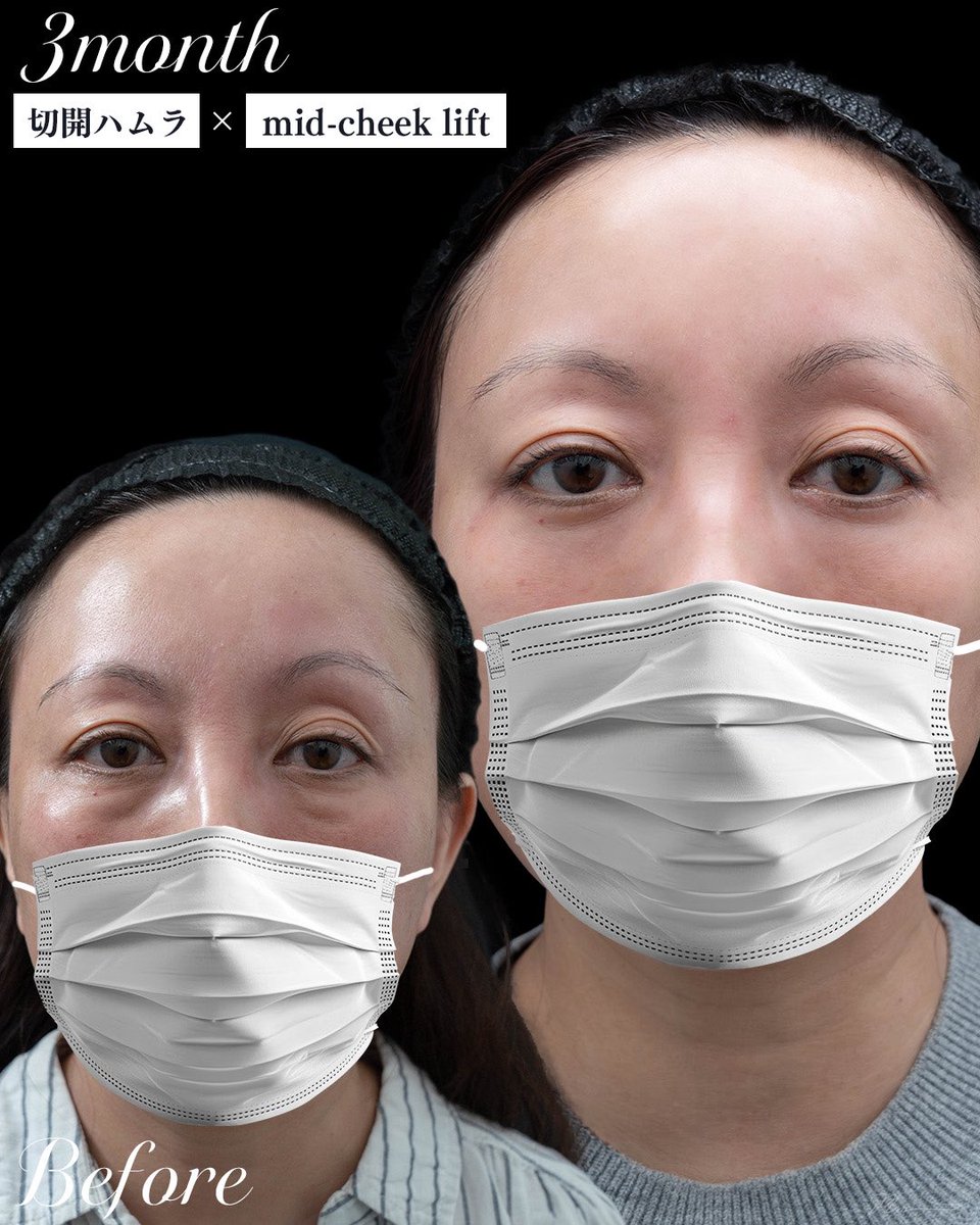 sbc_mizuguchi's tweet photo. 切開ハムラ ＋ midcheek lift ＋ ナノリッチ（48歳女性）

中顔面の位置がキュッと引き上がり、右側にあったゴルゴラインの影感もすっきり解消。目元から頬にかけて自然で滑らかなラインに整いました。
術前〜3ヶ月後までの経過変化です。 

施術のポイントと経過の詳細は⬇️ https://t.co/gu5GN90Hw9