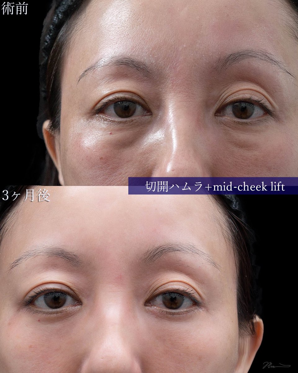 sbc_mizuguchi's tweet photo. 切開ハムラ ＋ midcheek lift ＋ ナノリッチ（48歳女性）

中顔面の位置がキュッと引き上がり、右側にあったゴルゴラインの影感もすっきり解消。目元から頬にかけて自然で滑らかなラインに整いました。
術前〜3ヶ月後までの経過変化です。 

施術のポイントと経過の詳細は⬇️ https://t.co/gu5GN90Hw9