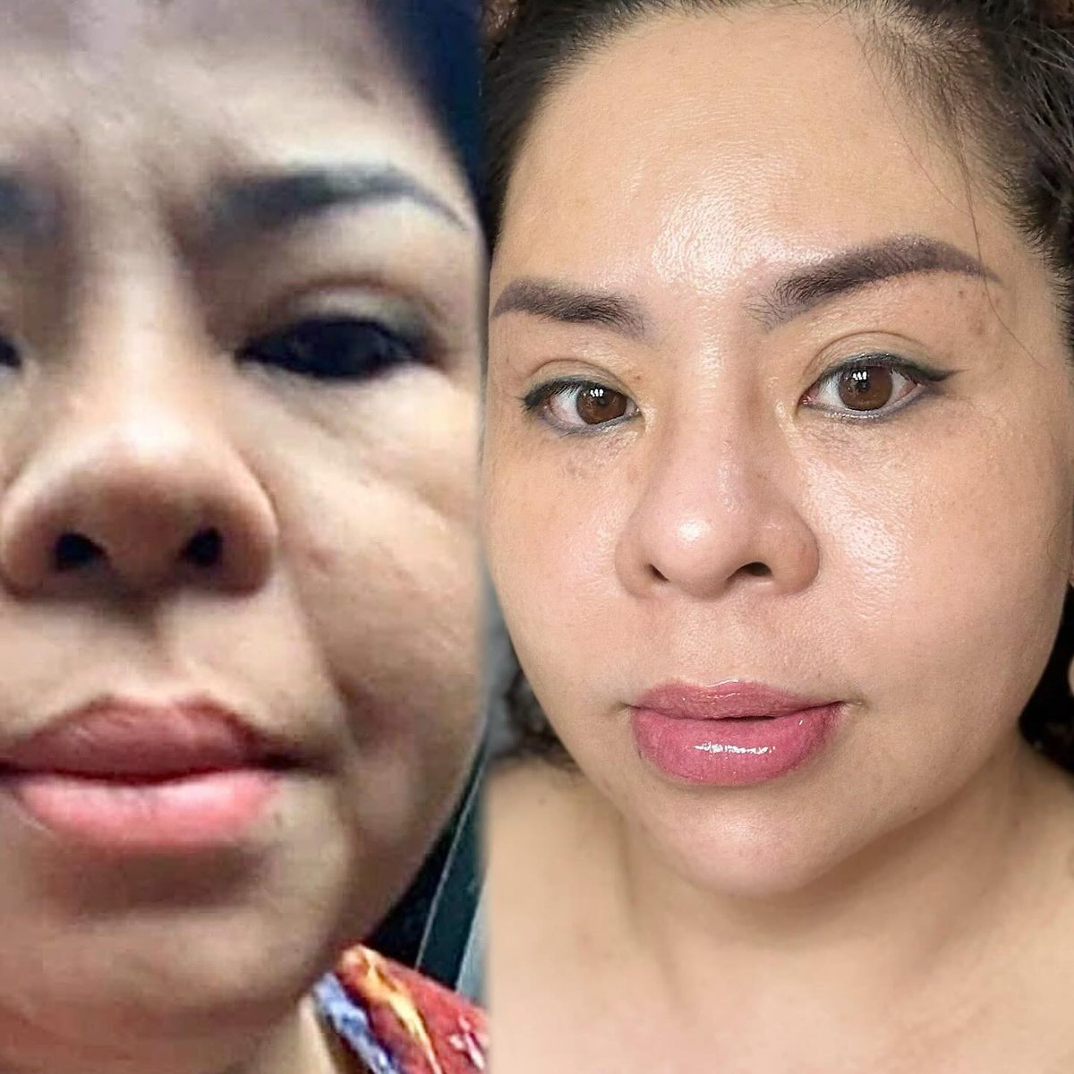 evertomsr's tweet photo. PLASMA FIBROBLAST – NOW IS THE BEST TIME

Get tighter, smoother, younger-looking skin without surgery. Cooler weather means faster healing, less irritation, and lower pigmentation risk. Ideal for eyelids, under-eyes, wrinkles, and neck lines. https://t.co/M7620SDbym