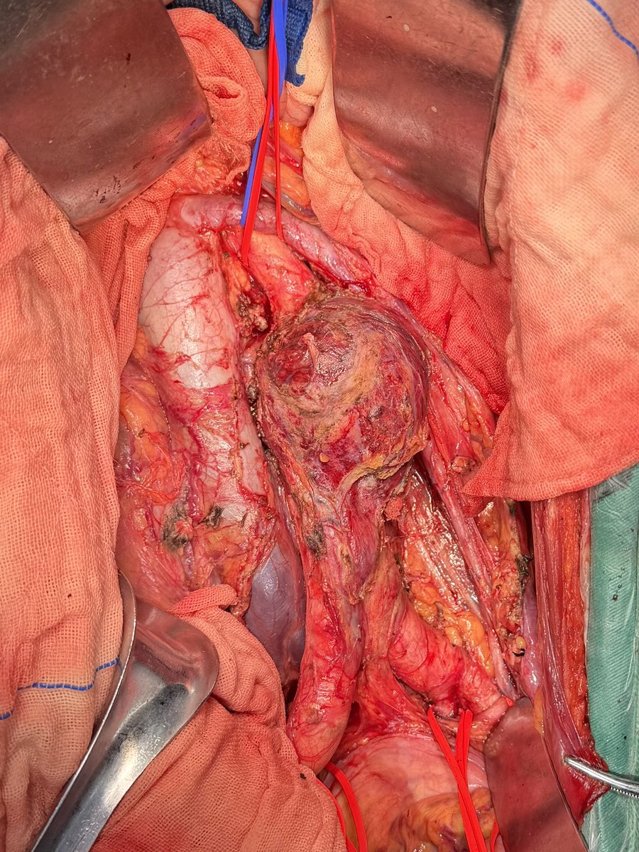 yuejianing's tweet photo. Infected native AAA with duodenal erosion: We separated the adherent erosed duodenum, followed by en bloc resection of the entire aneurysm and aortoiliac segment to achieve radical debridement. #AortaEd https://t.co/HUtdgpXGg6