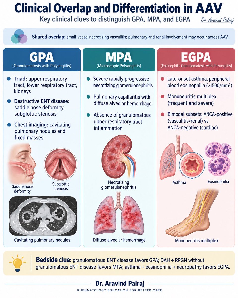 Rheumat_Aravind's tweet photo. GPA, MPA, and EGPA can all present as ANCA-associated vasculitis—but the clinical phenotype often tells you where to look.

GPA → destructive ENT disease + pulmonary nodules/cavitation + GN
MPA → RPGN + pulmonary capillaritis/DAH, without granulomatous ENT disease
EGPA → asthma + eosinophilia + neuropathy; ANCA status often tracks phenotype

The overlap is real. The pattern is the clue.

#Vasculitis #Rheumatology #AAV #ANCA #MedEd @IhabFathiSulima @docakx