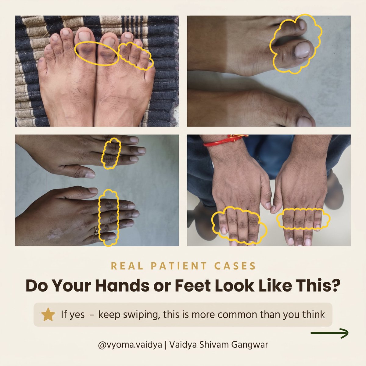 VyomaVaidya's tweet photo. Your knuckles are trying to tell you something 👀

That dark ring around your joints isn’t dirt or dryness - Ayurved calls it Parva Sandhi Krishnata, your body venting excess internal heat through your hands and feet.

Swipe through, then go check your own hands 👇 https://t.co/pMWjGVX7n1